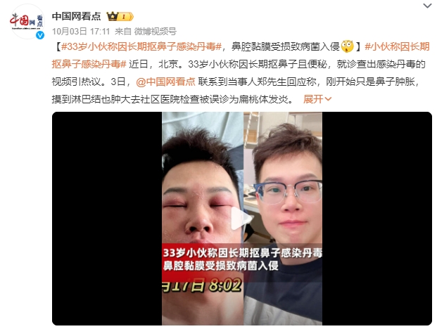 小伙称因长期抠鼻子感染丹毒：面部肿胀到眼睛睁不开