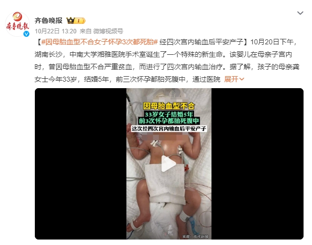 因母胎血型不合女子怀孕3次都死胎 第4胎经四次宫内输血后平安产子