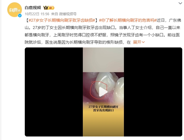27岁女子长期横向刷牙致牙齿缺损 医生：长期横向刷牙导致楔形缺损