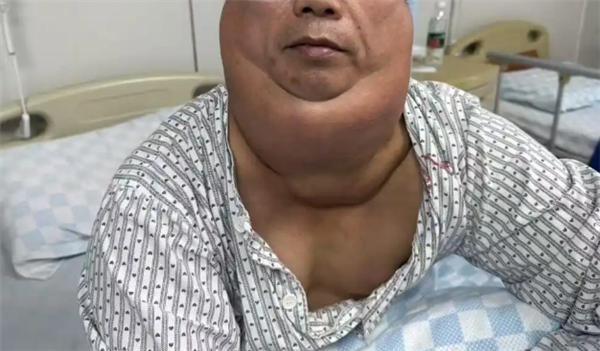 男子每天1斤酒喝出“河马颈” 医生：长期饮酒警惕脂肪异常堆积