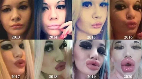 你爱了吗 女子花2.8万美元丰唇：嘴唇像充气气球自称世界最大