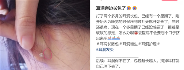 为什么没有人告诉我？打耳洞后会长这种肉疙瘩啊？