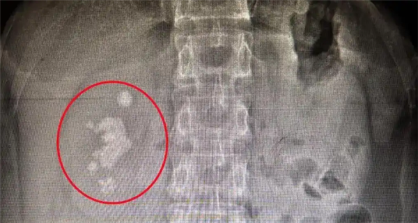 男子查出肾结石未重视拖成大麻烦：发展为铸型结石填满肾脏