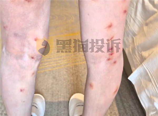 女子住酒店被跳蚤咬70多个包：酒店没赔偿 挂号费都是自己出的