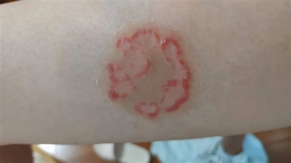 与银屑病斗争16年 我曾以为这辈子都找不到对象