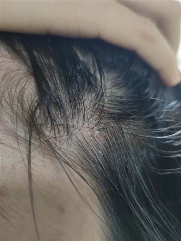 与银屑病斗争16年 我曾以为这辈子都找不到对象