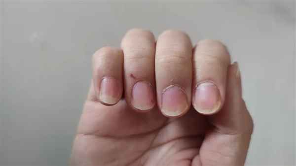 与银屑病斗争16年 我曾以为这辈子都找不到对象