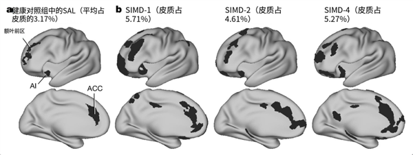 抑郁症病人的大脑到底发生了什么 真相惊人？