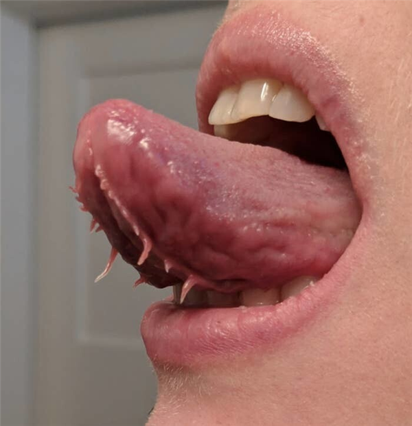 男子舌头天生异常：下面竟然长着两条“流苏”！
