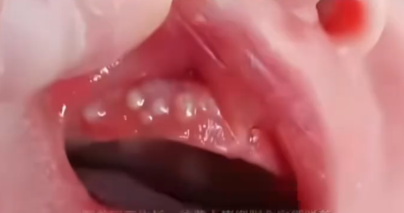 消毒险酿致命错！2个月宝宝被奶奶擦碘伏进ICU